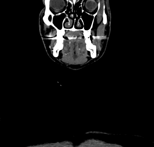 File:Carotid body tumor (Radiopaedia 83615-98727 B 22).jpg