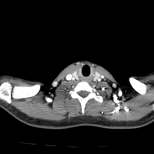 File:Carotid bulb pseudoaneurysm (Radiopaedia 57670-64616 A 56).jpg