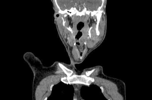 File:Carotid bulb pseudoaneurysm (Radiopaedia 57670-64616 C 2).jpg