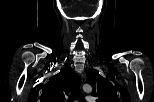 File:Carotid bulb pseudoaneurysm (Radiopaedia 57670-64616 D 66).jpg