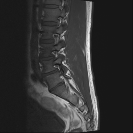 File:Cauda equina syndrome (Radiopaedia 53615-59672 Axial T1 12).png