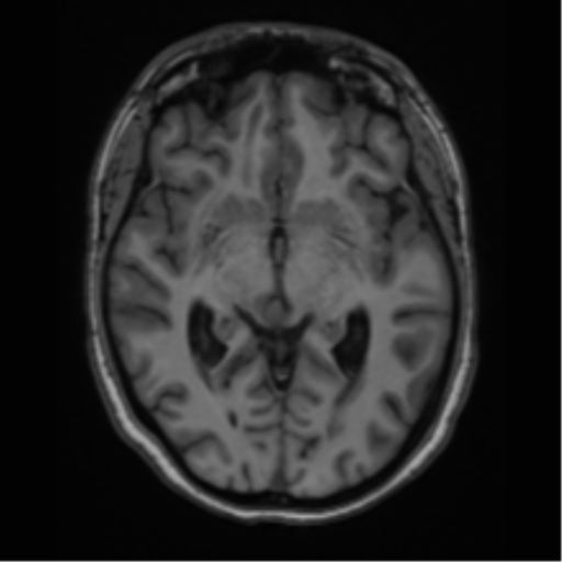 Cavernoma with bleed - midbrain (Radiopaedia 54546-60774 Axial T1 18).png