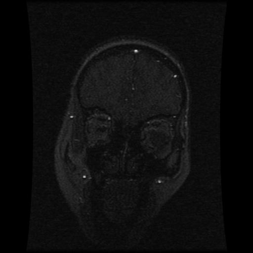 Cavernoma with developmental venous anomaly (Radiopaedia 22470-22507 MRV 104).jpg