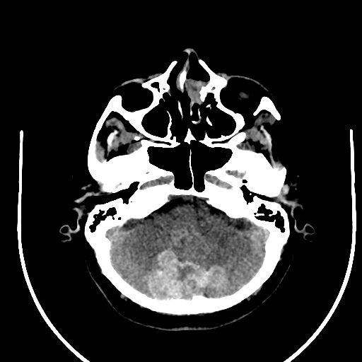Cavernous hemangioma of the cerebellar falx (Radiopaedia 73025-83723 Axial non-contrast 29).jpg