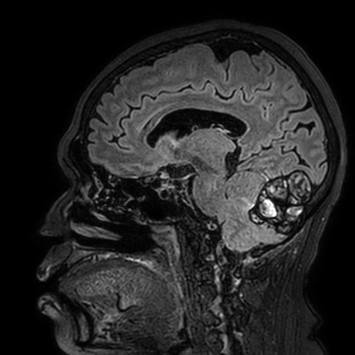 Cavernous hemangioma of the cerebellar falx (Radiopaedia 73025-83724 Sagittal FLAIR 124).jpg