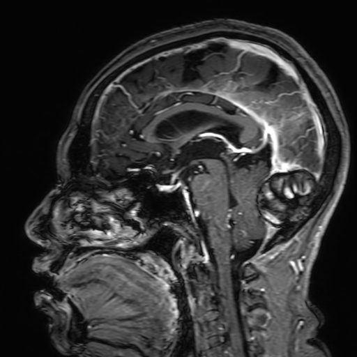 Cavernous hemangioma of the cerebellar falx (Radiopaedia 73025-83724 Sagittal T1 C+ 107).jpg