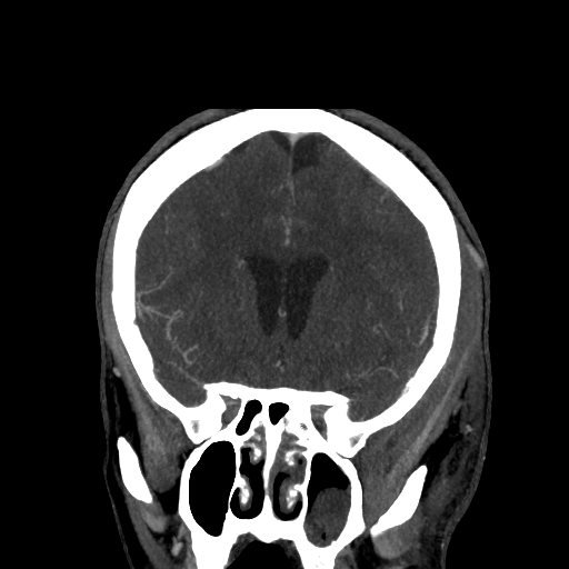 File:Cavernous sinus thrombosis (Radiopaedia 10619-11078 D 9).jpg