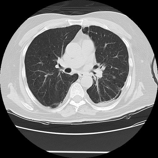 Cavitating pulmonary metastases (Radiopaedia 89545-106544 Axial lung window 27).jpg