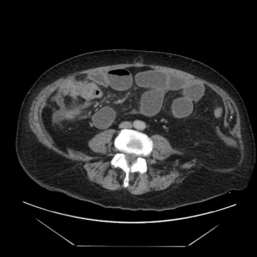 Cecal adenocarcinoma (Radiopaedia 64871-73817 A 59).jpg