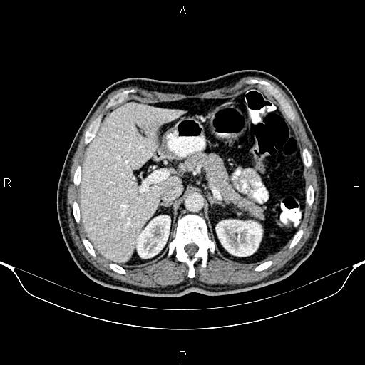 File:Cecal adenocarcinoma (Radiopaedia 85324-100916 B 24).jpg