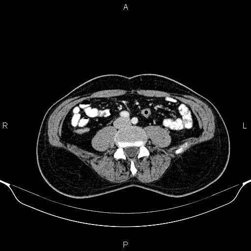 Cecal adenocarcinoma (Radiopaedia 85324-100916 B 60).jpg