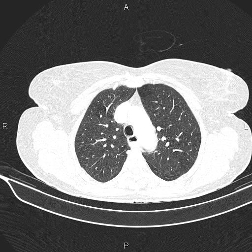 Cecal cancer (Radiopaedia 85610-101358 Axial lung window 20).jpg