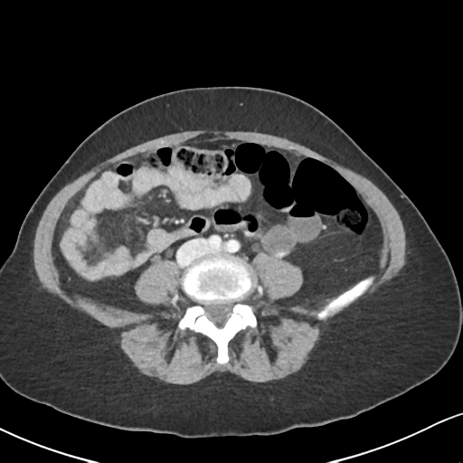 Cecal internal hernia through the foramen of Winslow (Radiopaedia 44820-48651 B 46).png