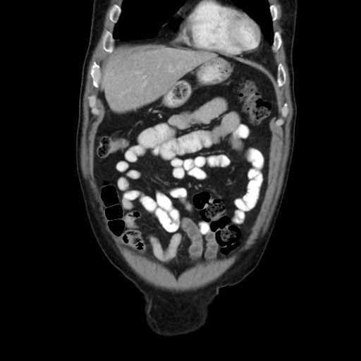 File:Cecal mass causing appendicitis (Radiopaedia 59207-66531 B 12).jpg