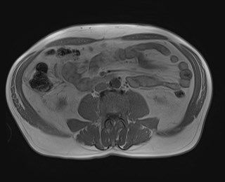 Cecal mass causing appendicitis (Radiopaedia 59207-66532 Axial T1 in-phase 77).jpg