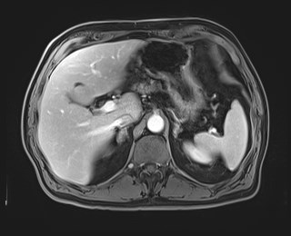 Cecal mass causing appendicitis (Radiopaedia 59207-66532 T1 C+ PV phase 41).jpg