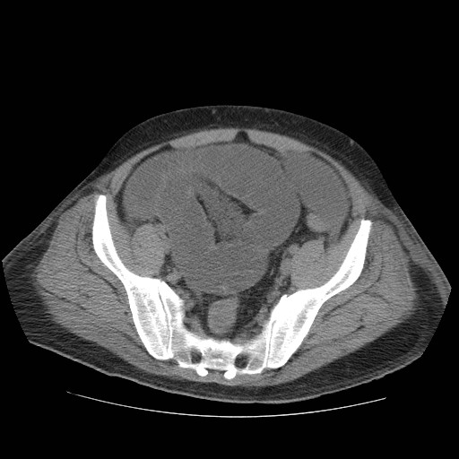 Cecal volvulus (Radiopaedia 28294-28534 Axial non-contrast 76).jpg