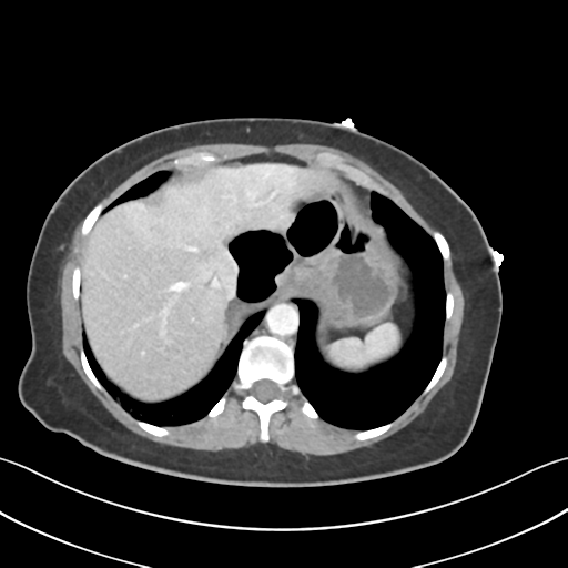Cecum hernia through the foramen of Winslow (Radiopaedia 46634-51112 A 13).png