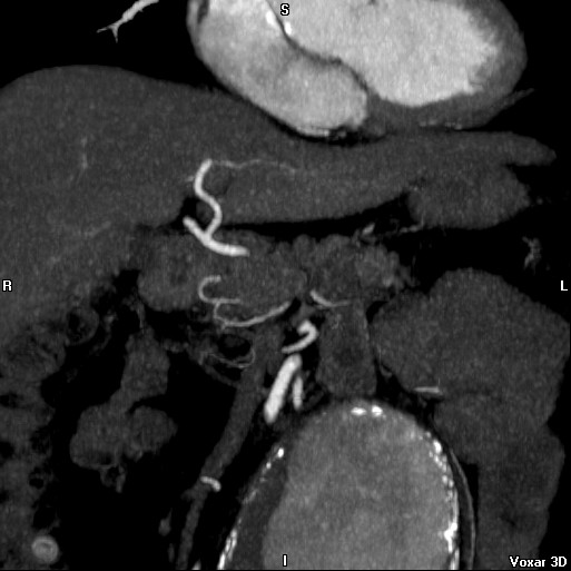 File:Celiac artery anatomy (Radiopaedia 16763-16476 A 2).jpg