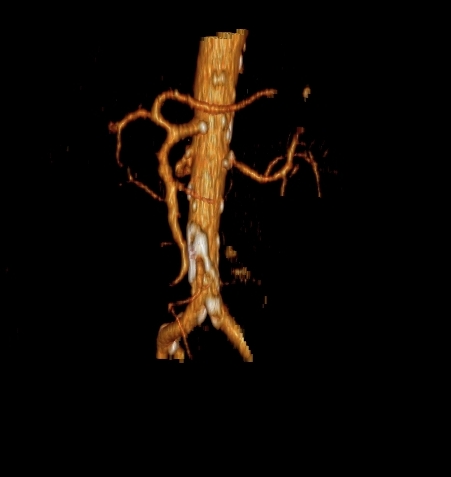 File:Celiacomesenteric trunk (Radiopaedia 67660-77071 VR C+ arterial phase 8).jpg