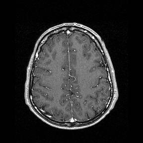 Central-variant posterior reversible encephalopathy syndrome (PRES) (Radiopaedia 43880-47358 Axial T1 C+ 124).jpg