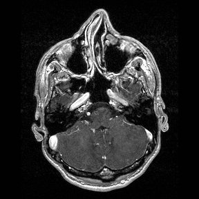 Central-variant posterior reversible encephalopathy syndrome (PRES) (Radiopaedia 43880-47358 Axial T1 C+ 29).jpg