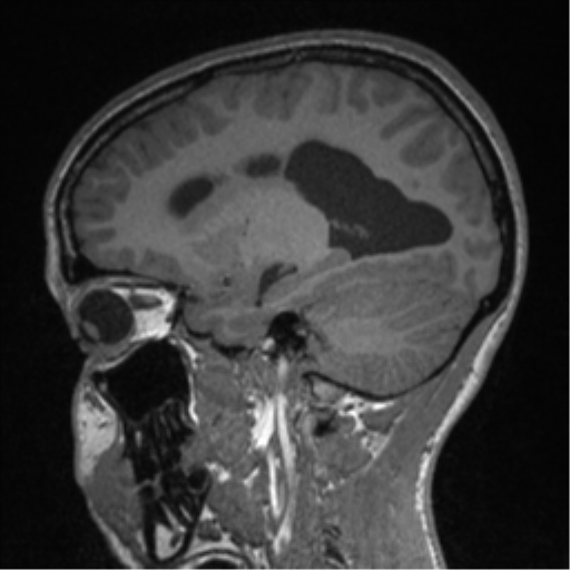Central neurocytoma (Radiopaedia 37664-39557 Sagittal T1 34).png