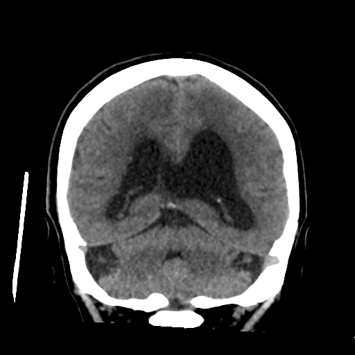 File:Central neurocytoma (Radiopaedia 65317-74346 Coronal non-contrast 40).png