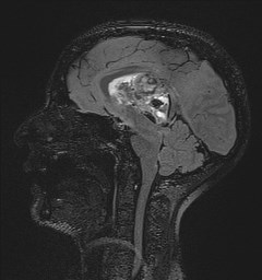 Central neurocytoma (Radiopaedia 84497-99872 Sagittal Flair + Gd 78).jpg
