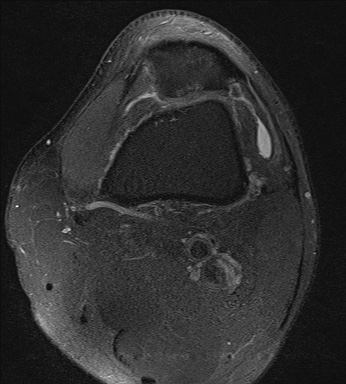 File:Central osteophyte (Radiopaedia 72592-83150 Axial PD fat sat 4).jpg