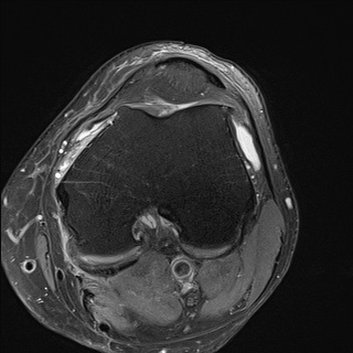 File:Central osteophyte (Radiopaedia 72592-83151 Axial PD fat sat 12).jpg