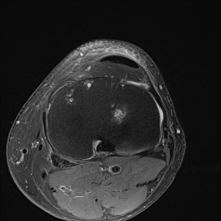 File:Central osteophyte (Radiopaedia 72592-83151 Axial PD fat sat 24).jpg