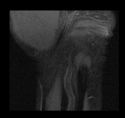 File:Central triangular fibrocartilage perforation (Radiopaedia 73346-84130 Coronal T1 fat sat 16).jpg