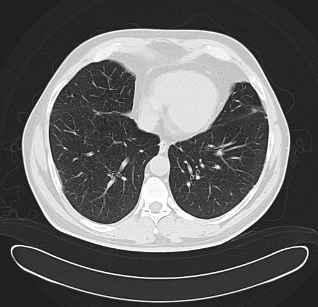 Centrilobular pulmonary emphysema (Radiopaedia 26808-26971 C 32).jpg