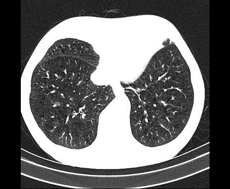 Centrilobular pulmonary emphysema (Radiopaedia 62468-70718 Axial lung window 59).jpg