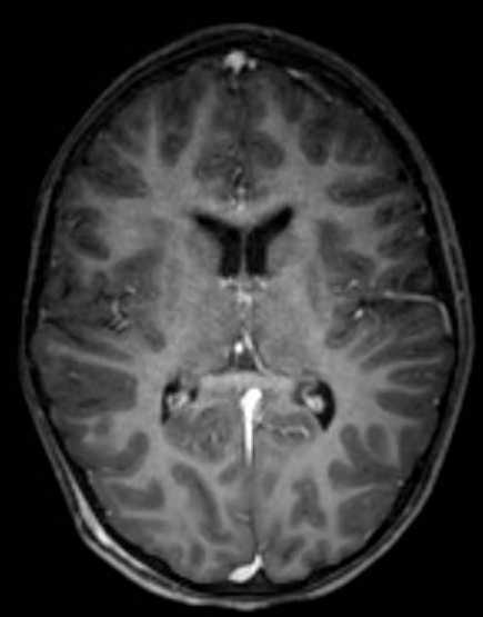 Cerebellar abscess (Radiopaedia 73727-84563 Axial T1 C+ fat sat 68).jpg