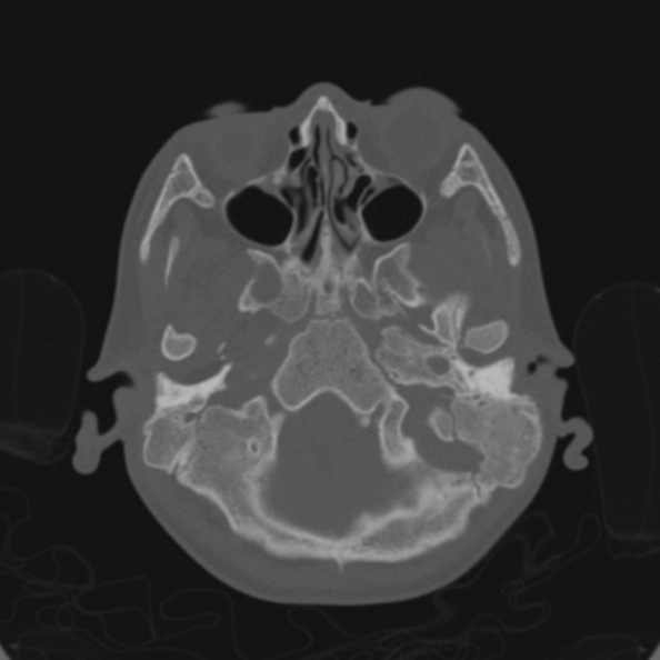 Cerebellar abscess secondary to mastoiditis (Radiopaedia 26284-26413 Axial bone window 31).jpg
