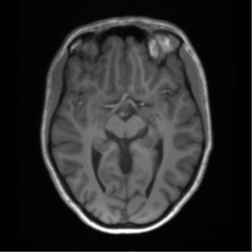 Cerebellar agenesis with hypoplastic pons (pontocerebellar hypoplasia) (Radiopaedia 57224-64138 Axial T1 35).png
