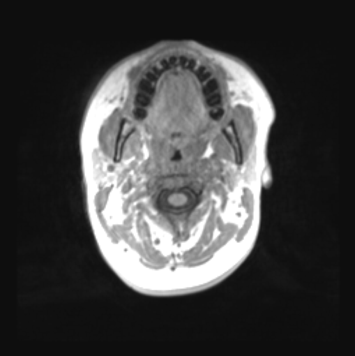 File:Cerebellar ependymoma complicated by post-operative subdural hematoma (Radiopaedia 83322-97736 Axial T1 1).png
