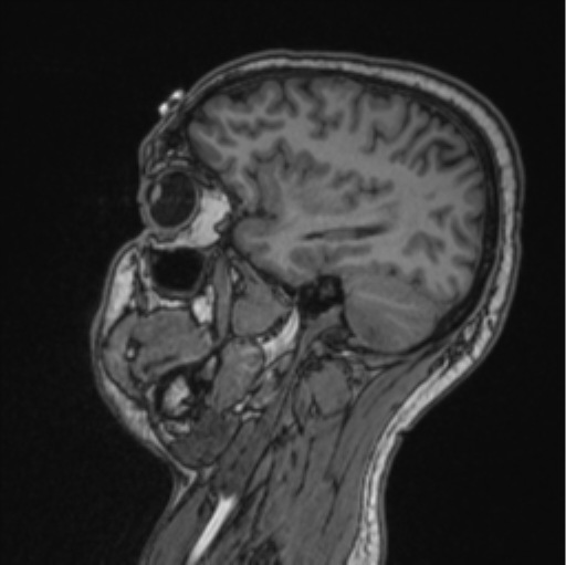 File:Cerebellar hemangioblastomas and pituitary adenoma (Radiopaedia 85490-101176 Sagittal T1 37).png