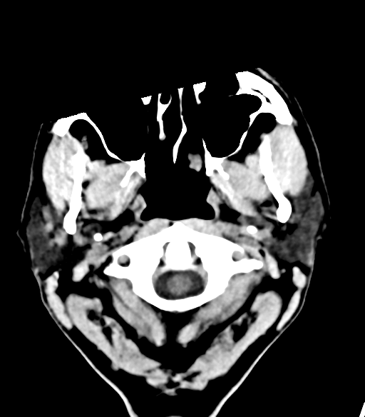 File:Cerebellar hemorrhage (Radiopaedia 37000-38669 Axial non-contrast 2).png