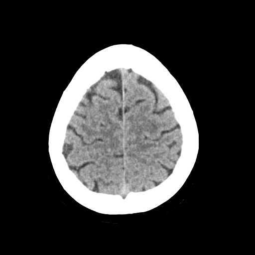 File:Cerebellar metastasis (Radiopaedia 54578-60812 Axial non-contrast 42).png