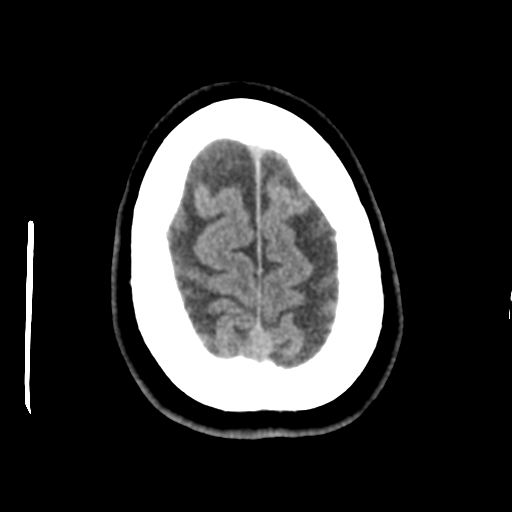 Cerebellar metastasis (cystic appearance) (Radiopaedia 41395-44258 Axial non-contrast 47).png