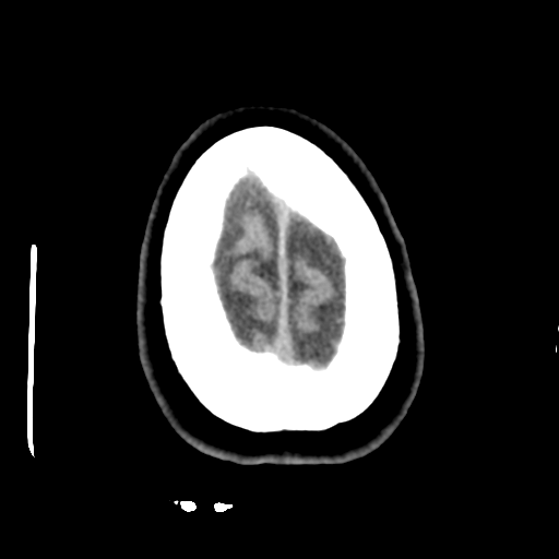 Cerebellar metastasis (cystic appearance) (Radiopaedia 41395-44258 Axial non-contrast 49).png