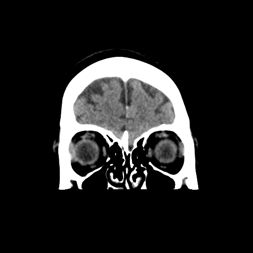 File:Cerebellar metastasis (cystic appearance) (Radiopaedia 41395-44258 Coronal non-contrast 13).png