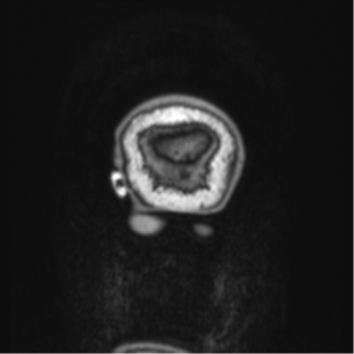 Cerebellar metastasis from lung adenocarcinoma (Radiopaedia 86690-102829 Coronal T1 1).png