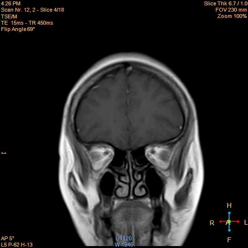 File:Cerebellopontine angle meningioma (Radiopaedia 22488-22525 Coronal T1 C+ 4).jpg