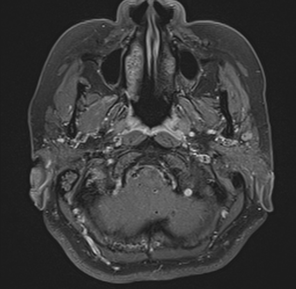 File:Cerebellopontine angle meningioma (Radiopaedia 53561-59591 Axial T1 C+ fat sat 2).jpg