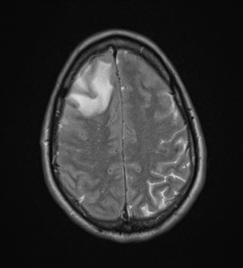 File:Cerebral abscess (Radiopaedia 60342-68009 Axial T2 28).png