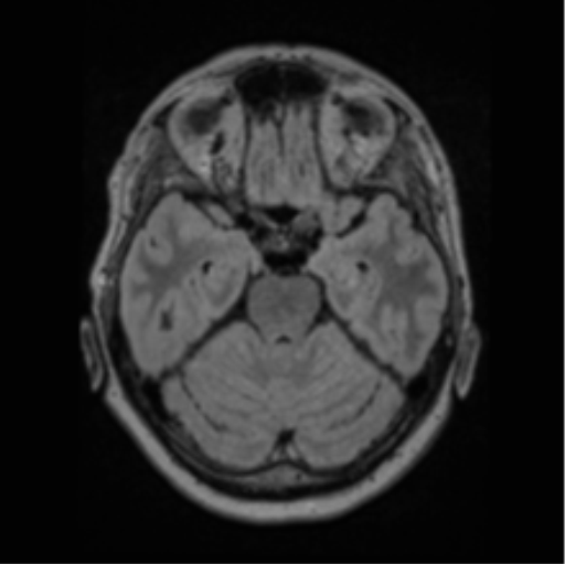 File:Cerebral abscess from pulmonary arteriovenous malformation (Radiopaedia 86275-102291 J 28).png